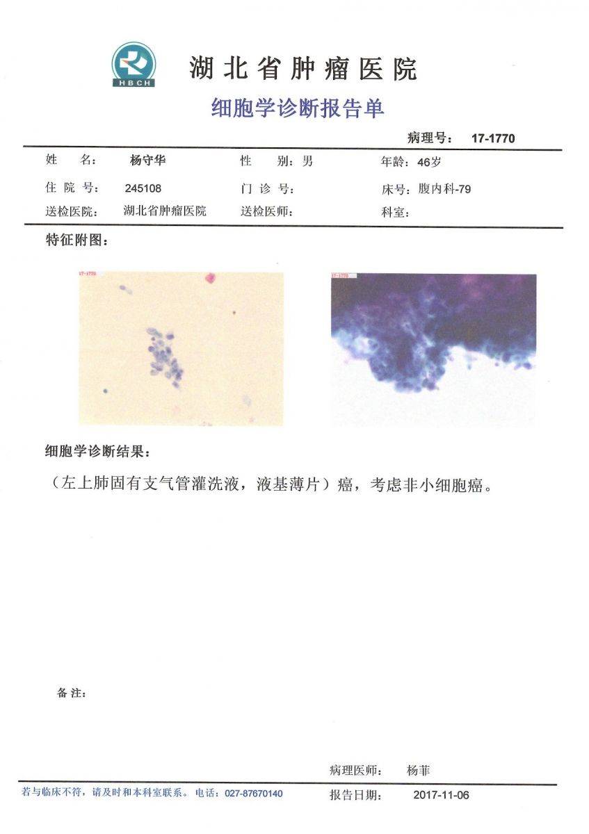 细胞学诊断报告单_典型病例_湖北省肿瘤医院
